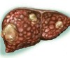 hepatite-b-1