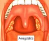 amigdalite
