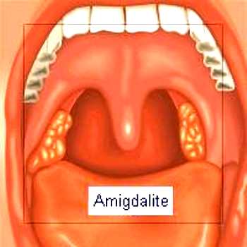 Amigdalite Amigdalite