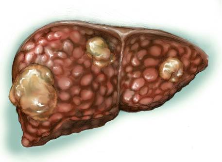 Fígado e Hepatite B Fígado e Hepatite B