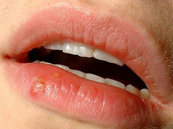 Detalhe Herpes Labial Detalhe Herpes Labial