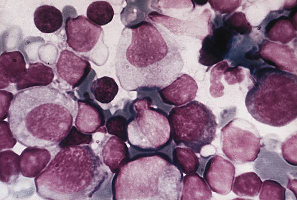 Mononucleose Mononucleose